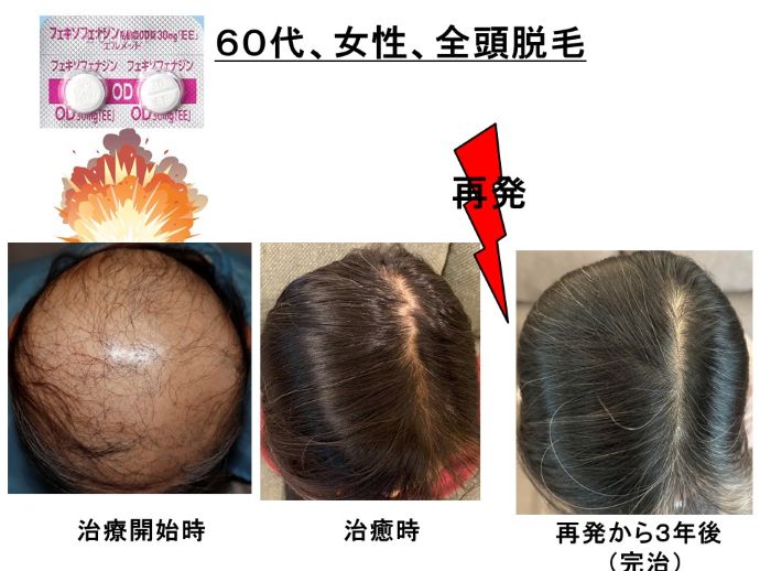 円形脱毛症　病院
